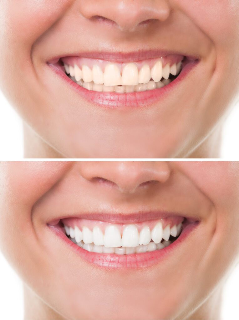 before and after whitening