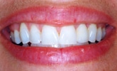 dental bridge after image konig center of dentistry