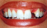 dental bridge before image konig center of dentistry