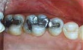 fillings1 bf