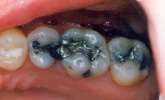 fillings2 bf