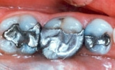 Porcelain onlays1 bf (Meta Dental Fillings))