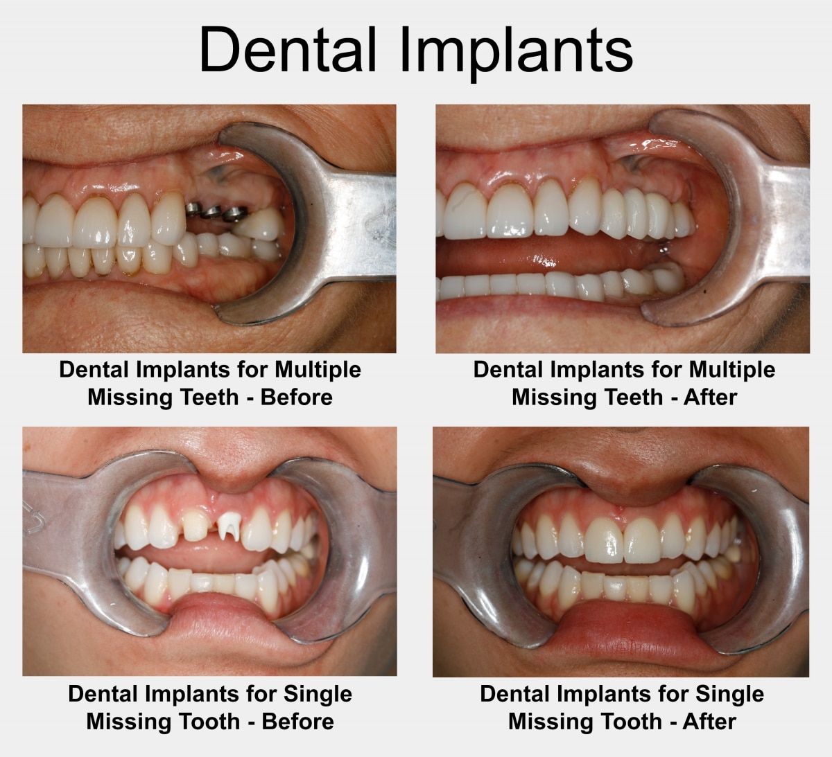 dentalimplants houstondentistdrkonig