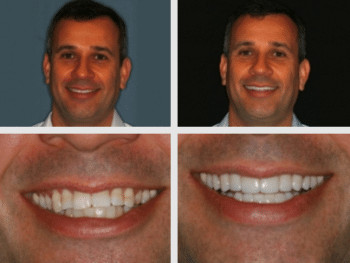 full mouth reconstruction before and after image patient 1