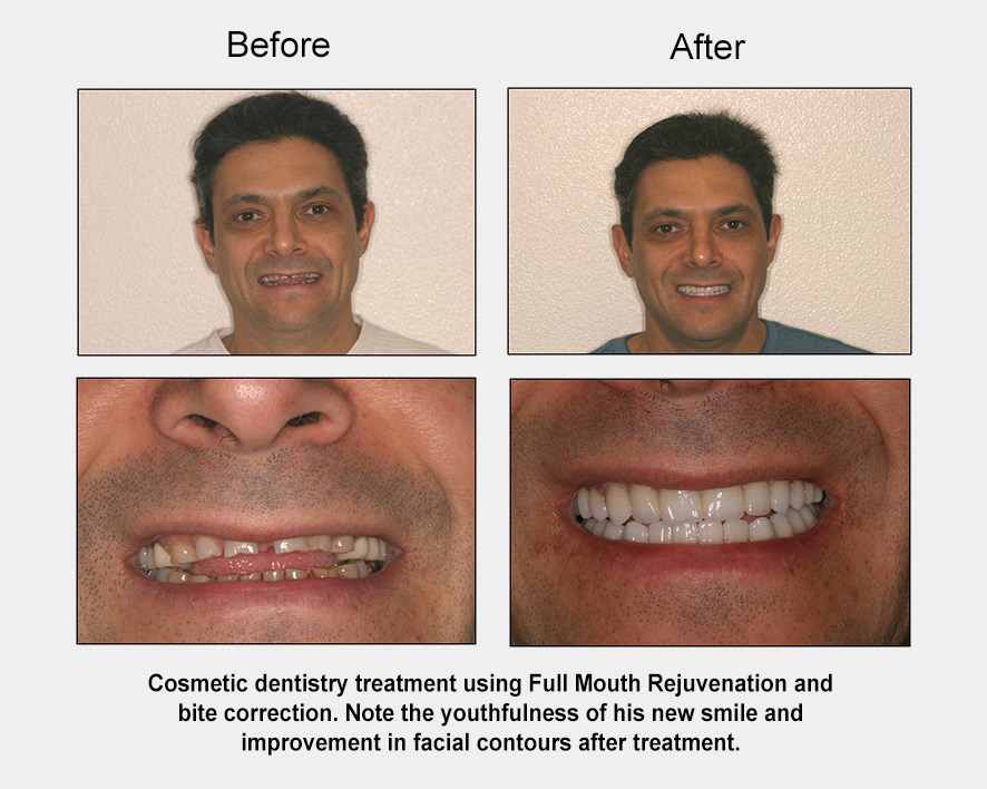 man smiling before and after full mouth rejuvenation cosmetic dentistry treatment, smile fuller and whiter afterwards