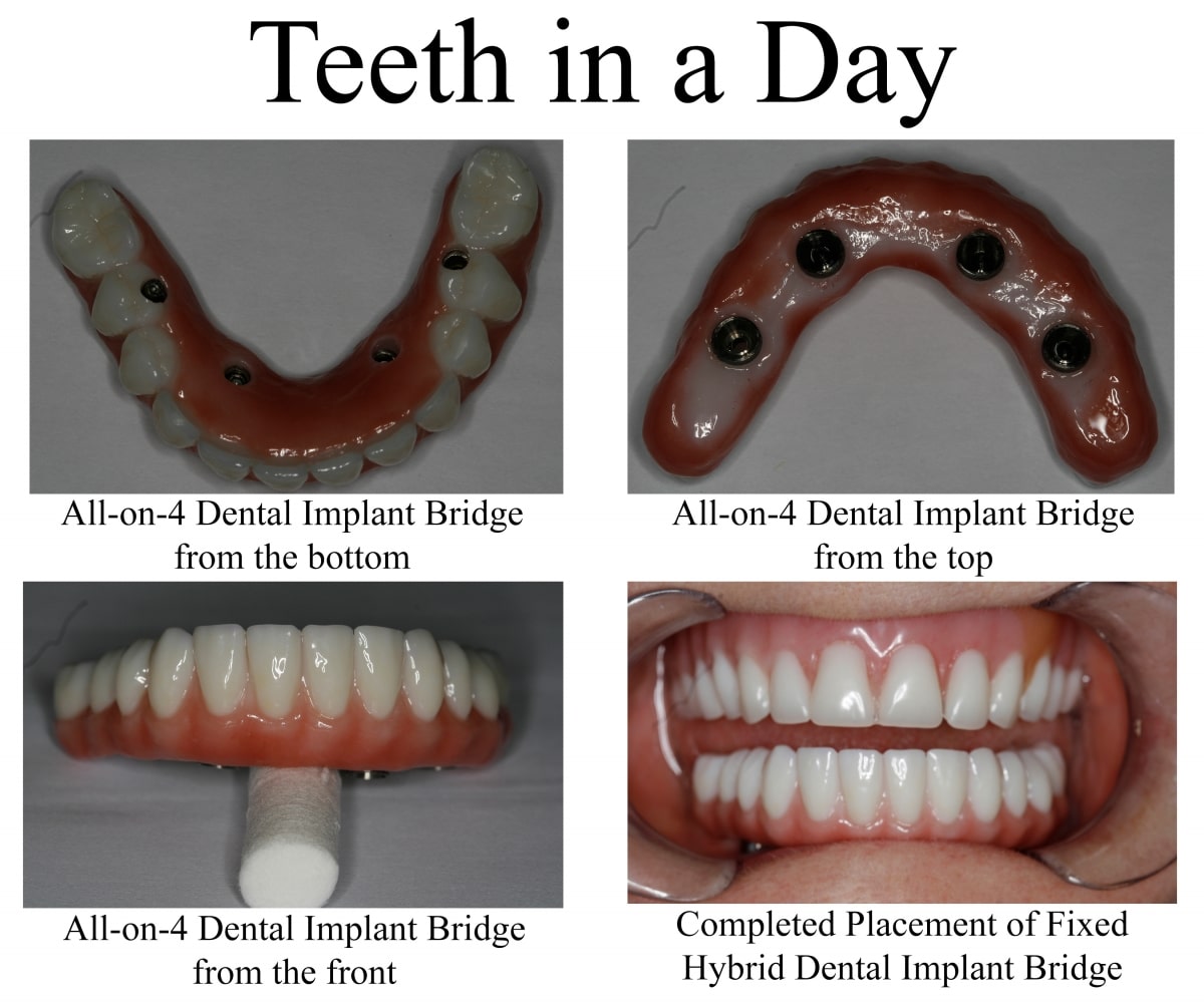 konig teeth in a day dental implants houston