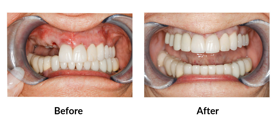 dental implants as cosmetic dental procedures
