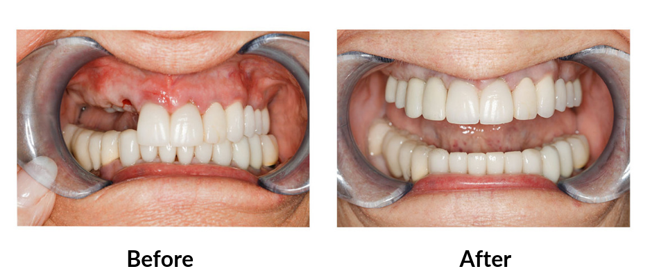 Is a Dental Implant Considered Cosmetic?