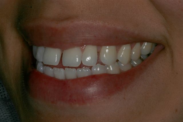 Before Dental Bonding