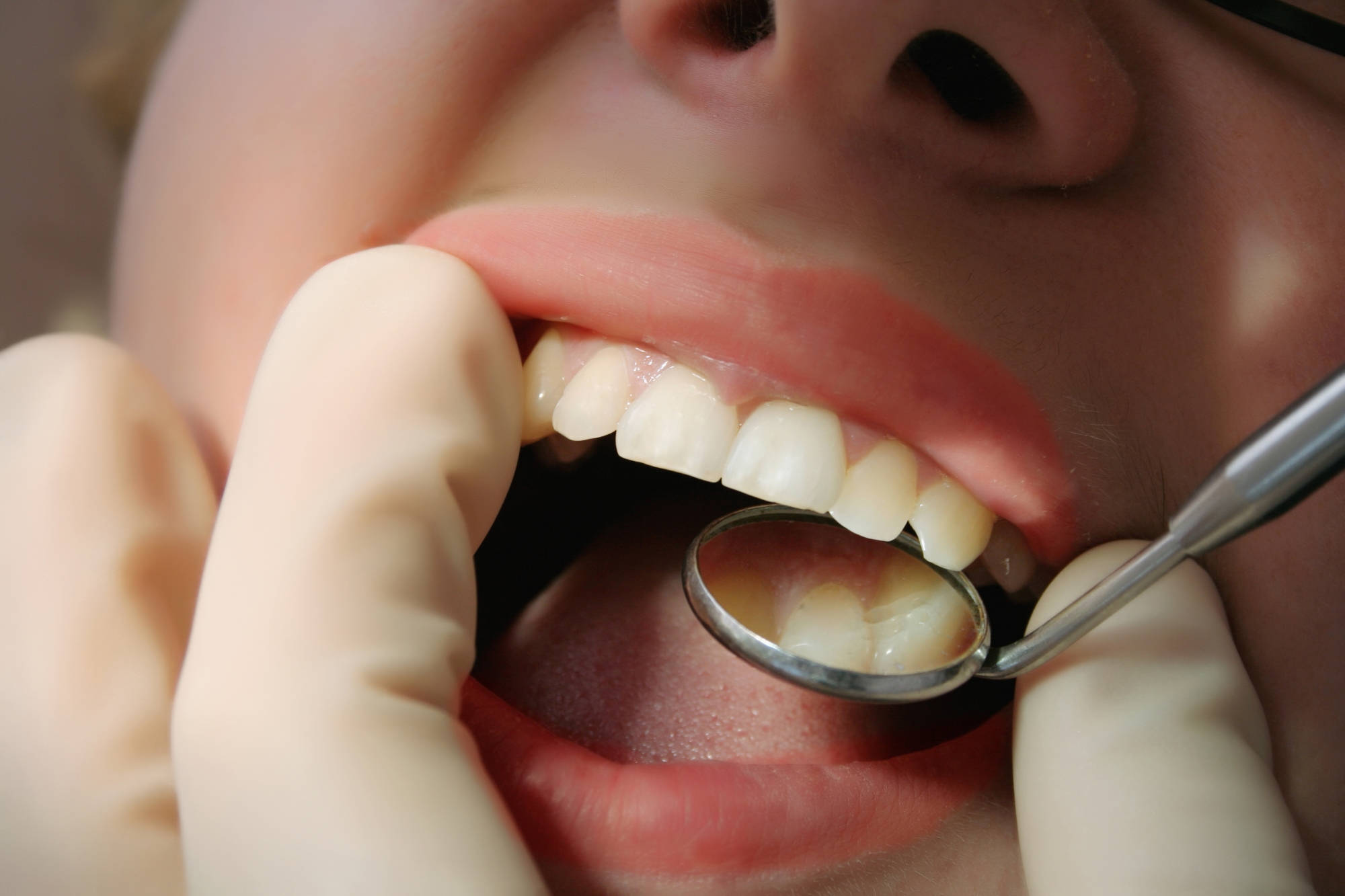 Dental Debridement in Houston