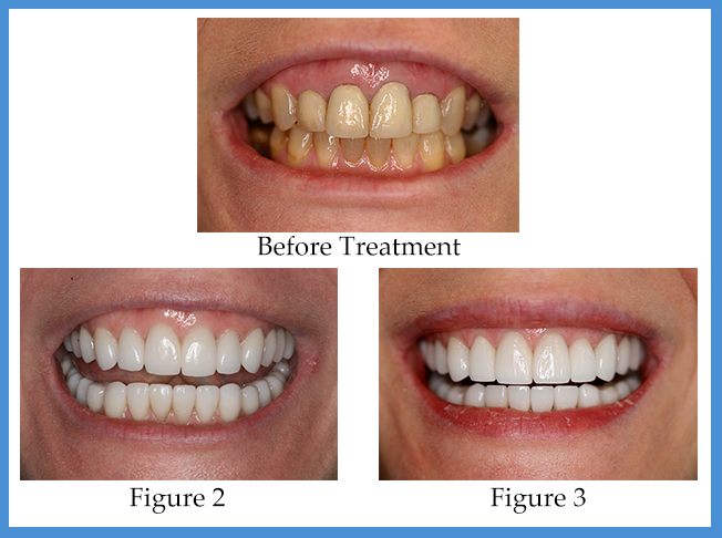 How Long Does The Porcelain Veneers Process Take? - Konig Center For Cosmetic & Comprehensive Dentistry