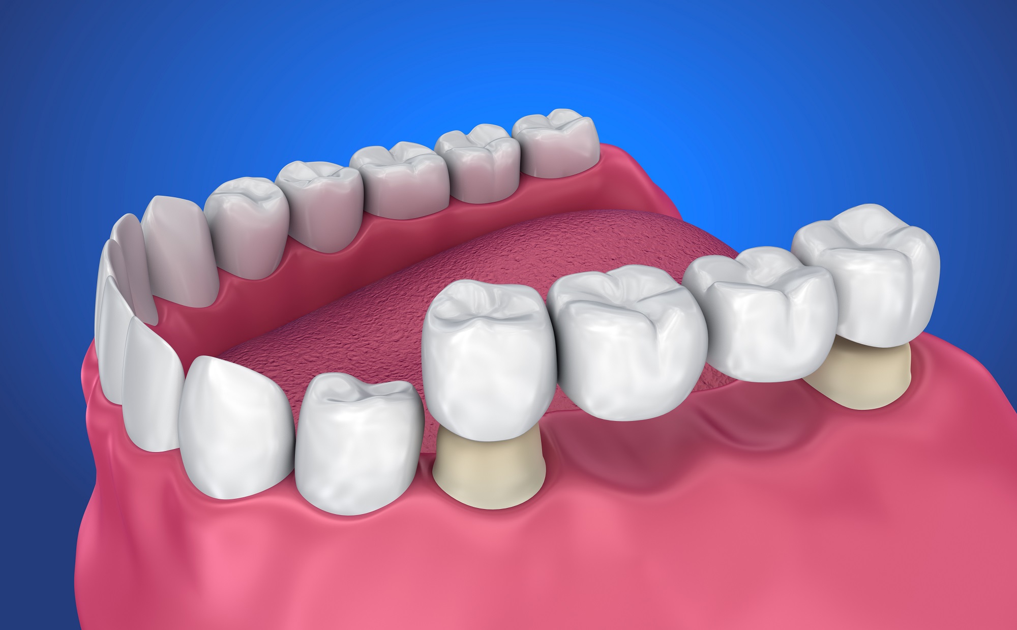 Fixed Dental Bridge | Houston Tooth Replacement Options