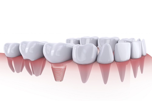 What Dental Implants Look Like | Houston, TX