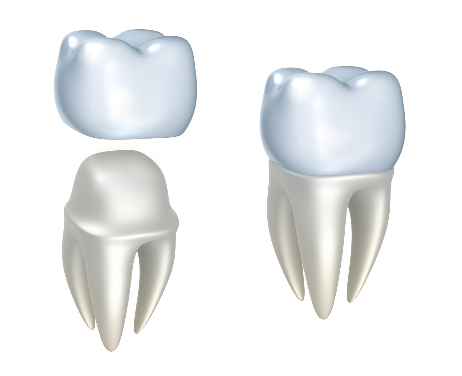 Tooth Crowns Houston | Implant Dentist