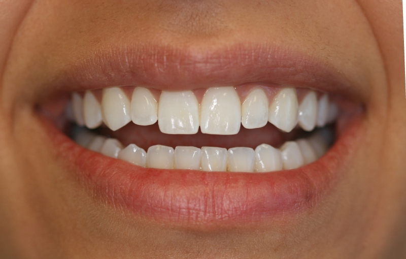 Conservative Non Prep Veneers(1)