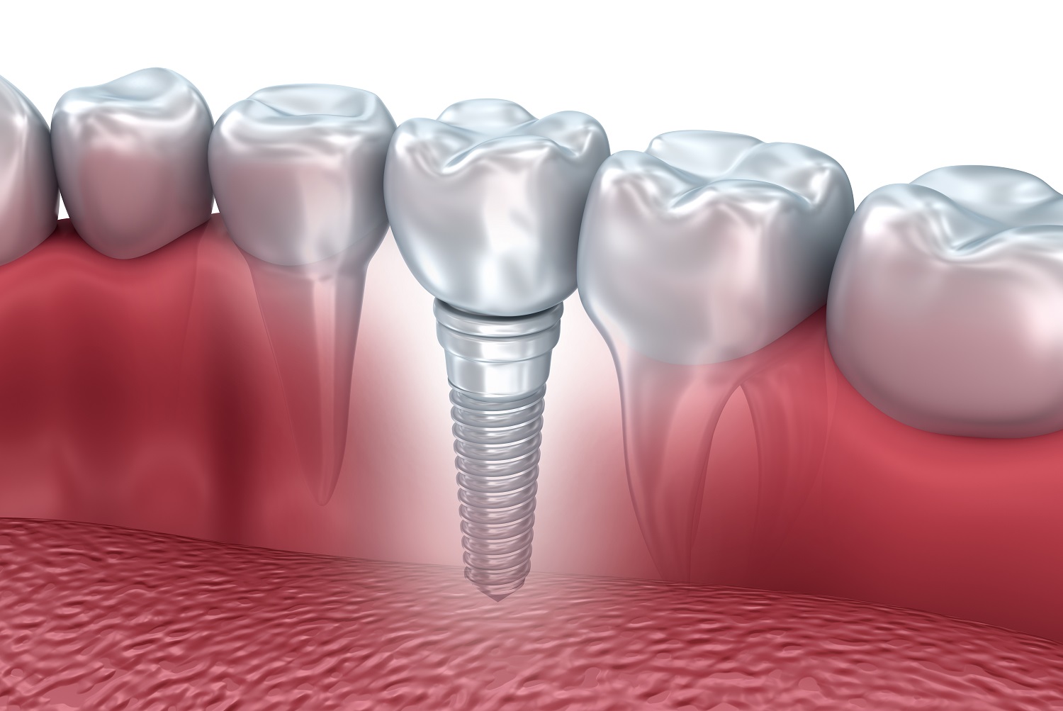 The True Cost of Dentures | Houston Tooth Replacement