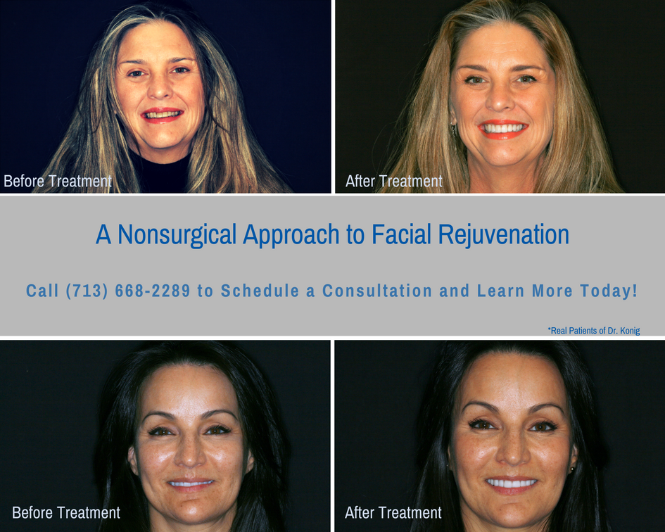 Non Surgical Face Lift with Dentistry