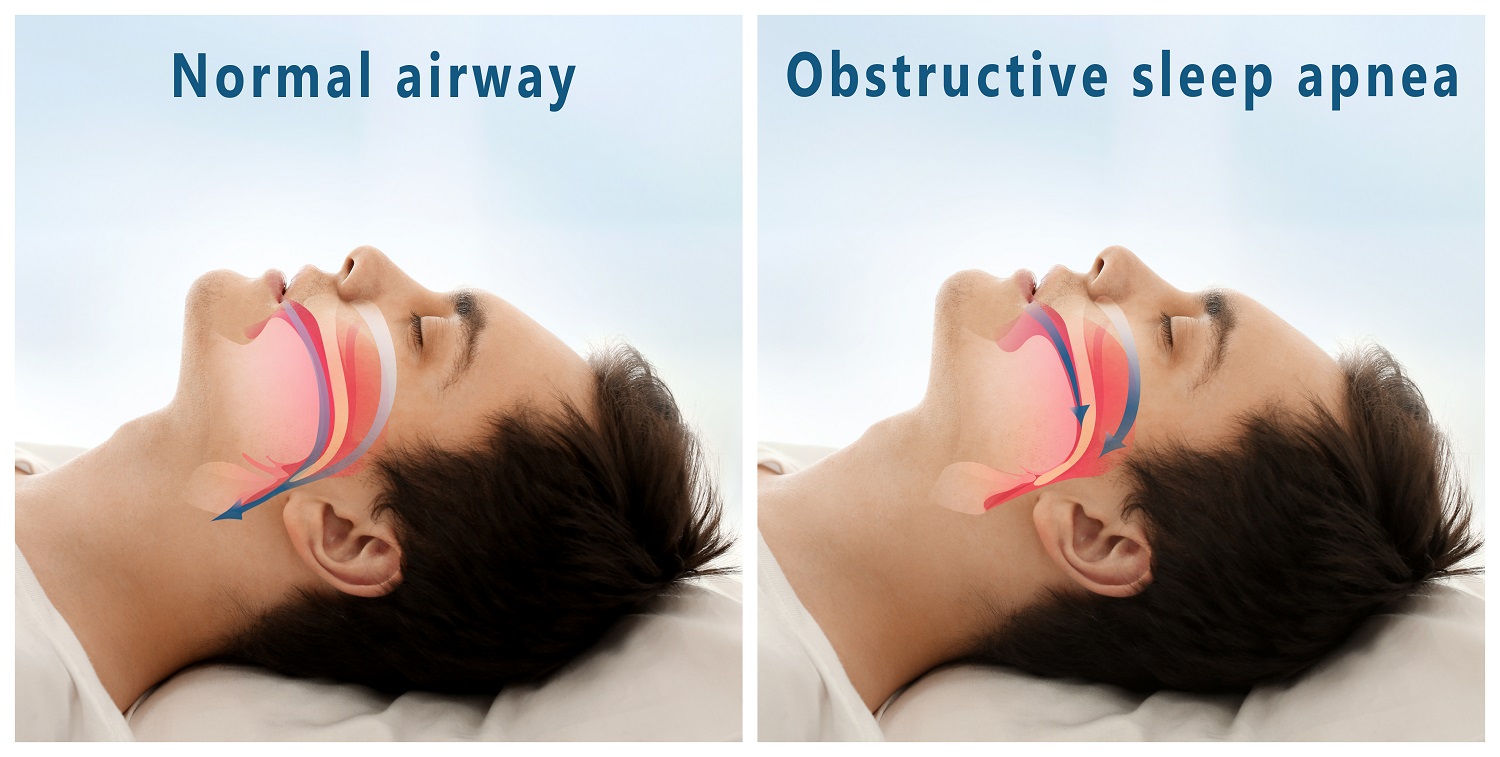 Airway Obstruction | OSA Treatment Houston