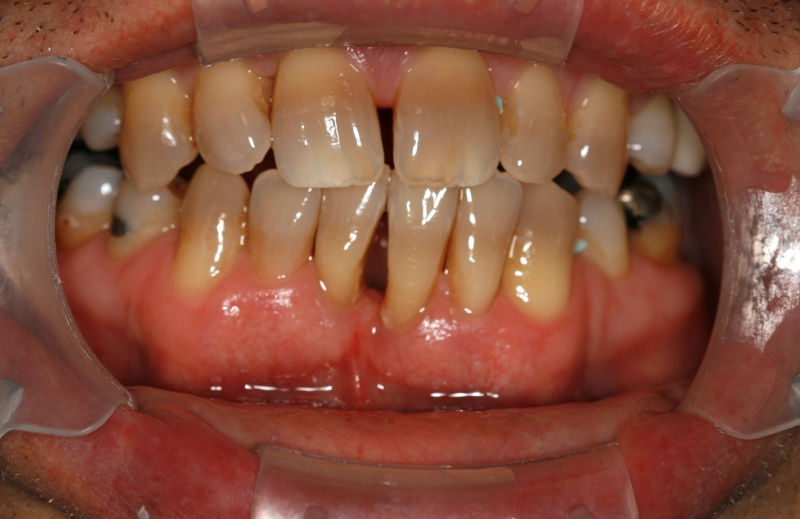 Before image of teeth with stains and gaps