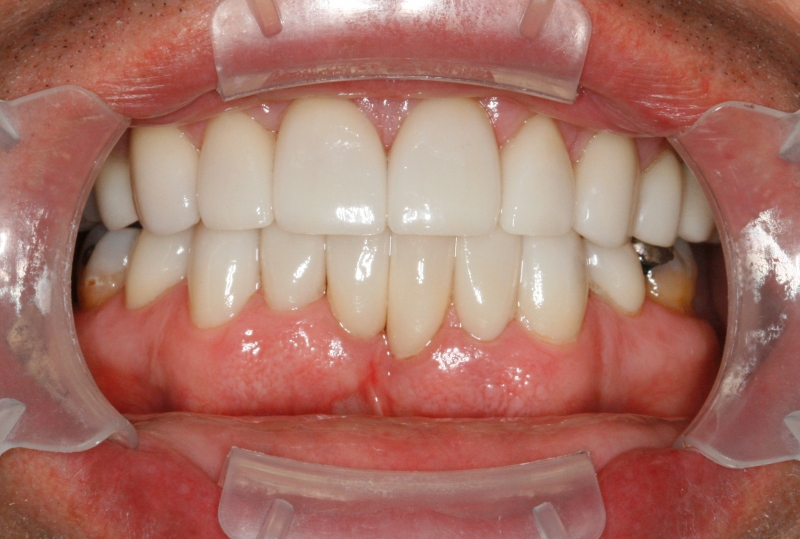 After image of white teeth with the new porcelain veneers. Stains and gaps are gone.