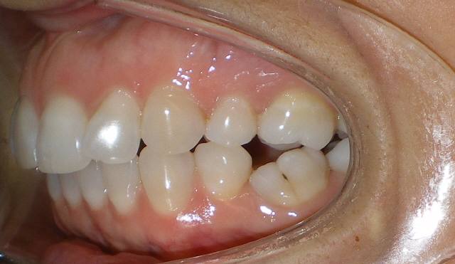 Four Bicuspid Extraction: Jaw Problems and Collapsed teeth - Dr Konig