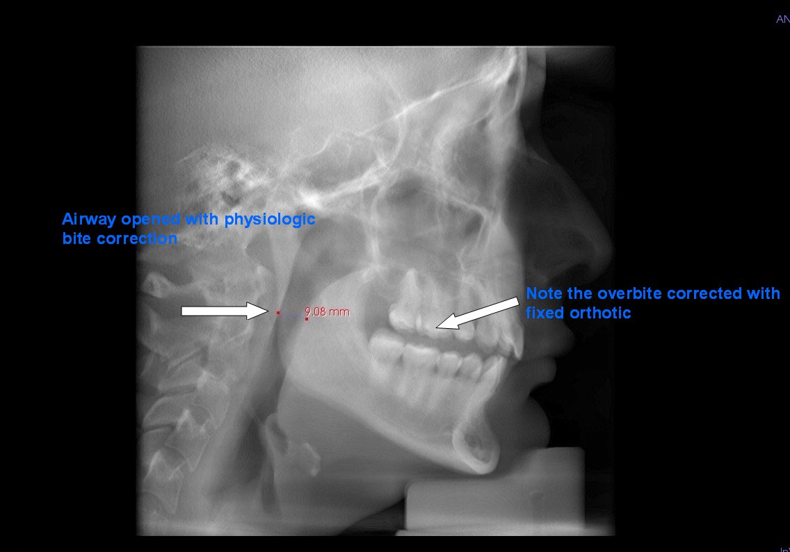 Bite corrected which opens the airway. Patient can now breath nasally
