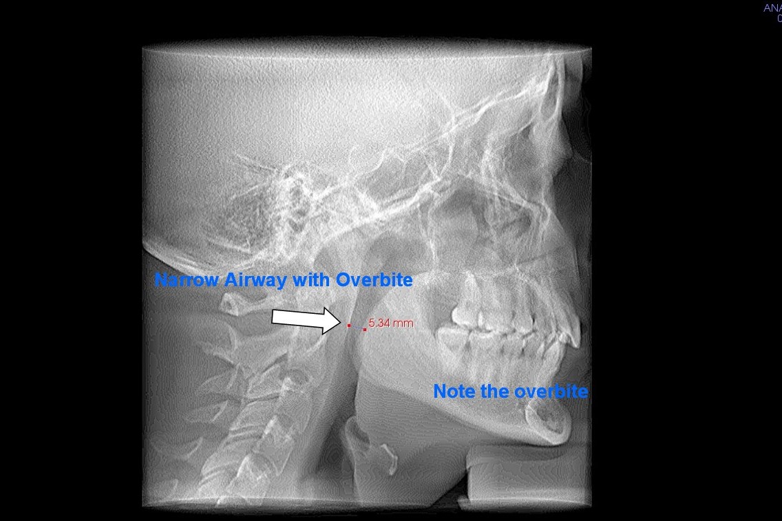 overbite closing the airway on a mouthbreather