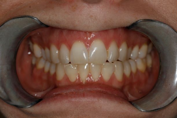 Narrow Upper Jaw Trapping Lower Jaw: Note Crowded Lower Teeth - Dr Konig in Houston
