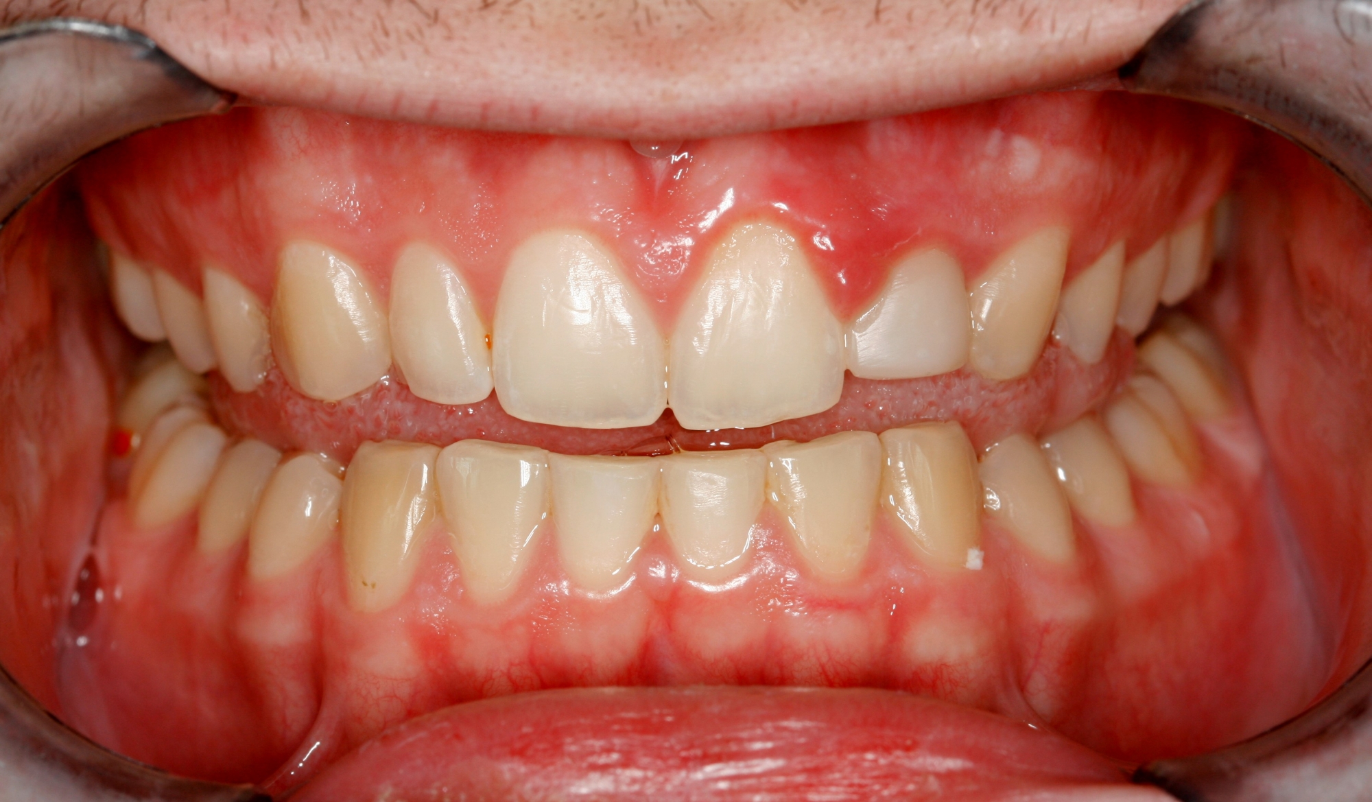 Can TMJ Cause Damage to my Teeth and Can this be fixed with Cosmetic