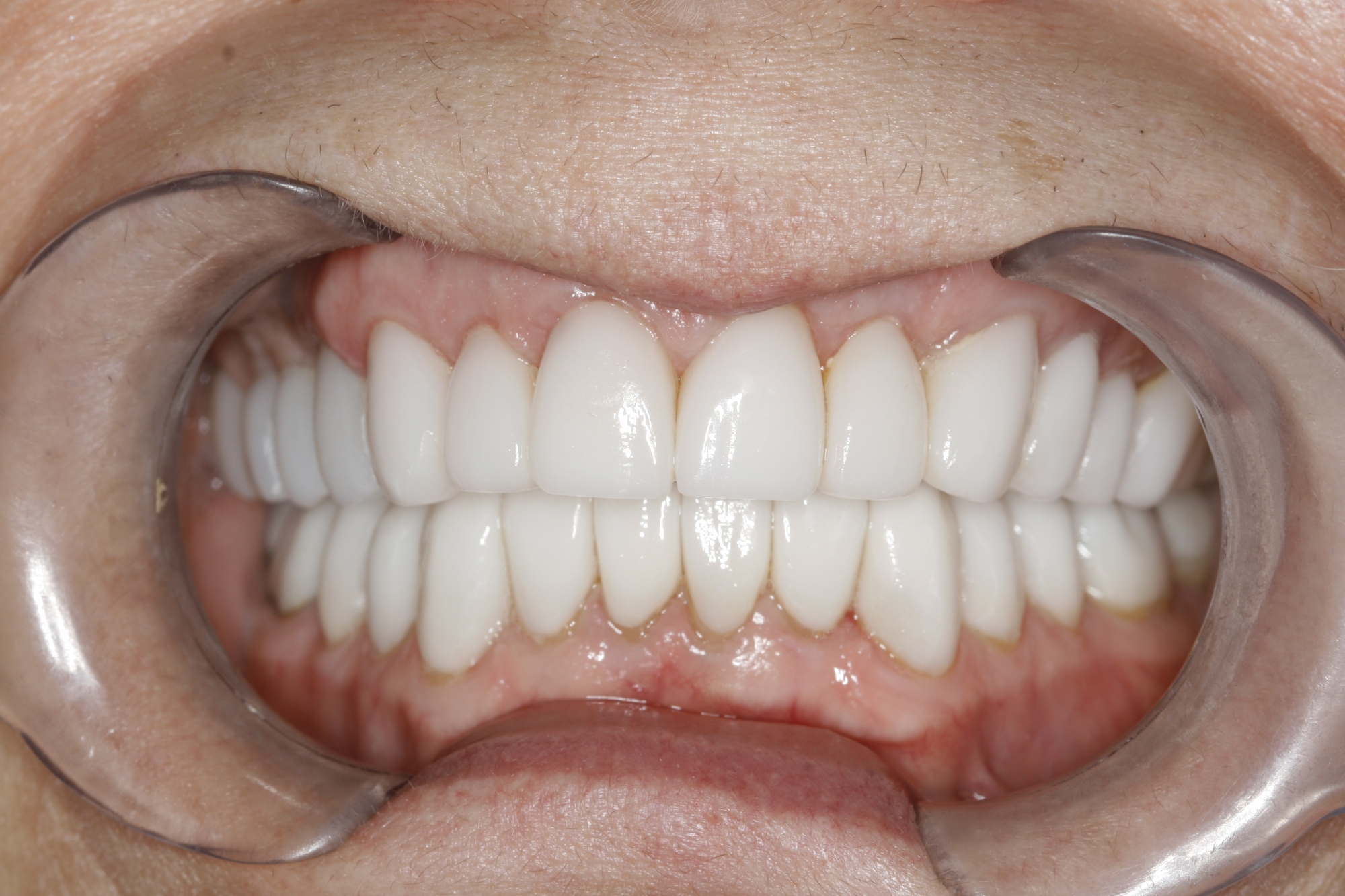 Can Overbites & TMJ Headaches Be Corrected with Crowns or Veneers?