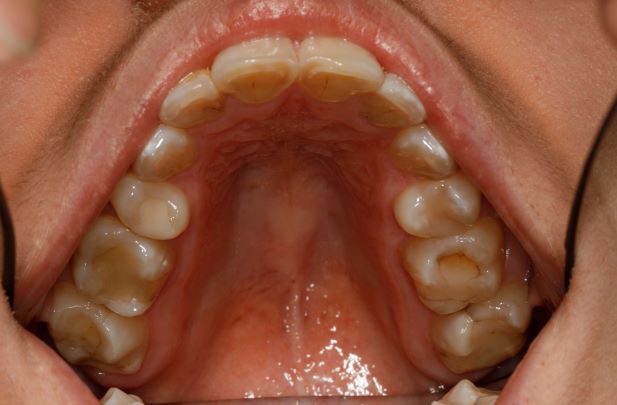 Narrow Upper Jaw and Bicuspid Extractions Creating Smaller Jaw - Dr Konig