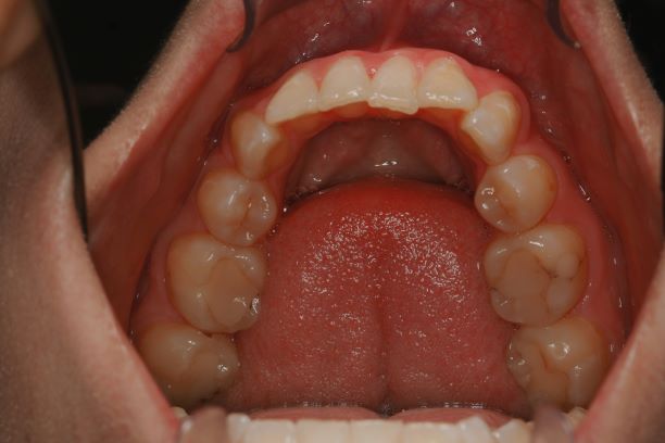 Very little Tongue Space and tipped in Teeth in lower jaw - Dr Konig