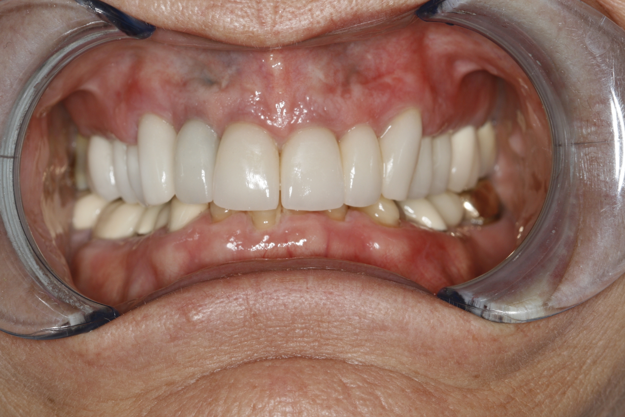Overbite Correction Without Surgery - Konig Center for Cosmetic &  Comprehensive Dentistry