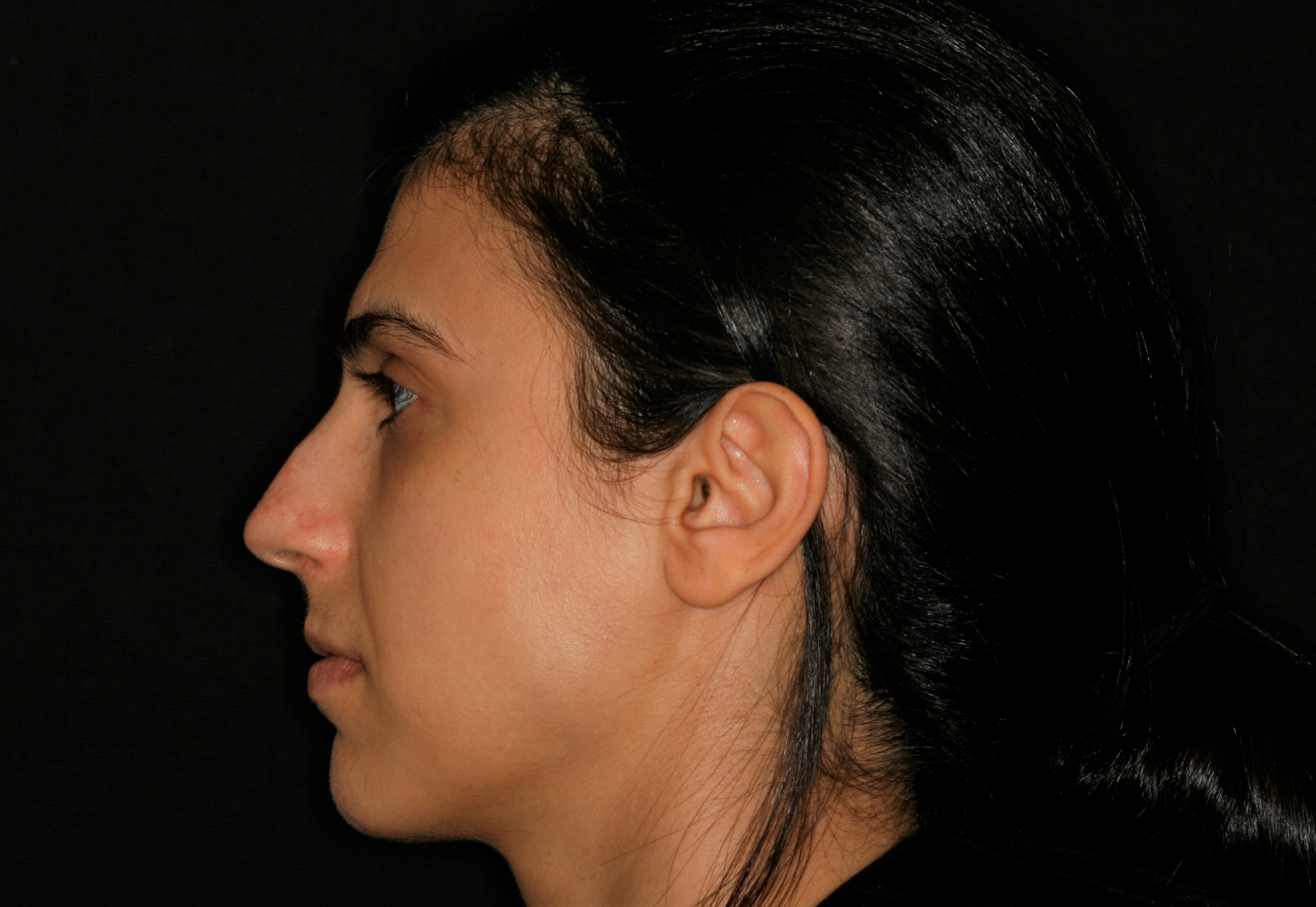 Corrected Overbite and TMJ issues with Fixed Orthotic
