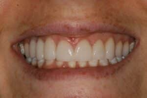 Porcelain Veneers