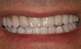 After Houston Porcelain Veneers