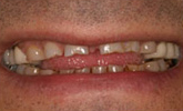 Before Houston Porcelain Veneers