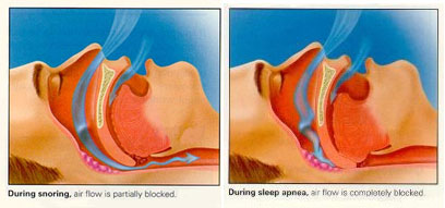 Houston Sleep Apnea Images