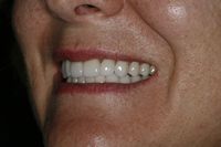 Veneers used to correct the tooth position and lip profiles