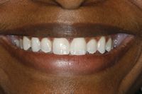 Teeth Whitening and Dental Bonding to close spaces