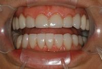 Dental Implants and porcelain crowns to restore smile and bite