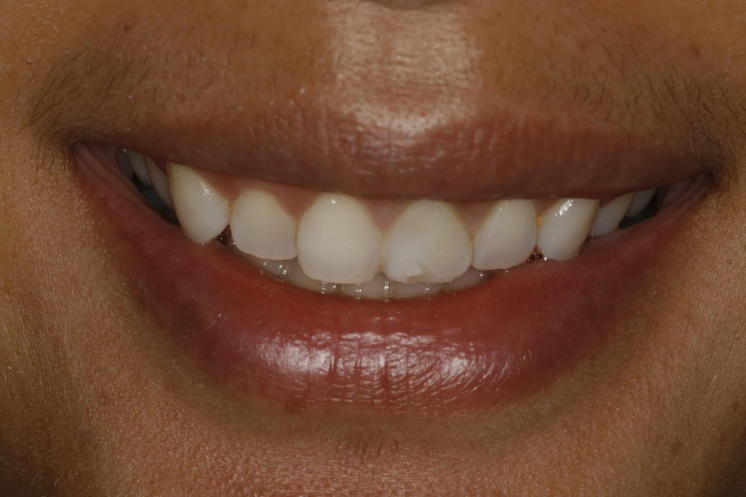 Can Porcelain Veneers make my teeth bigger? Houston Cosmetic Dentist