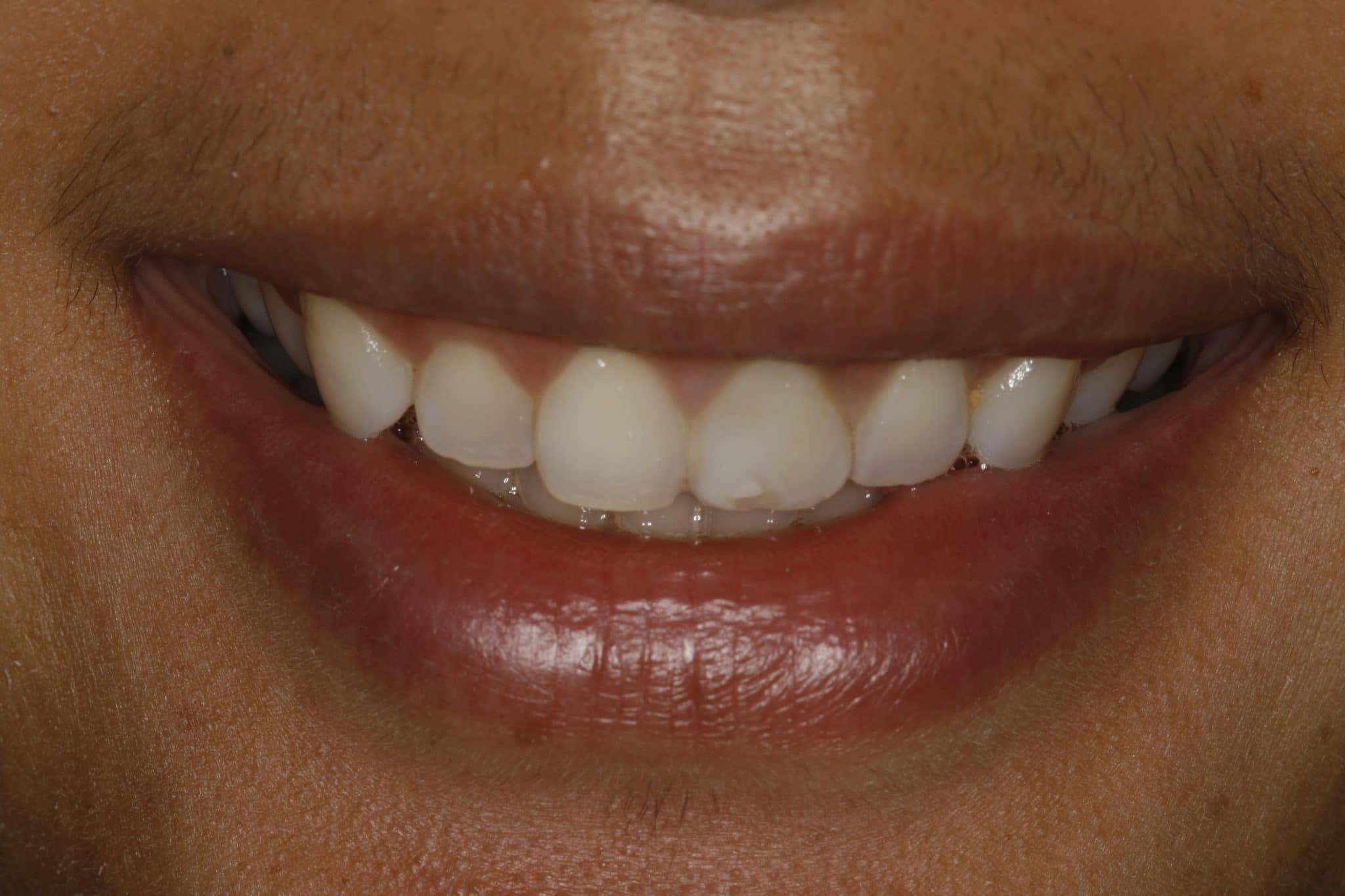 Can Porcelain Veneers make my teeth bigger? Houston Cosmetic Dentist