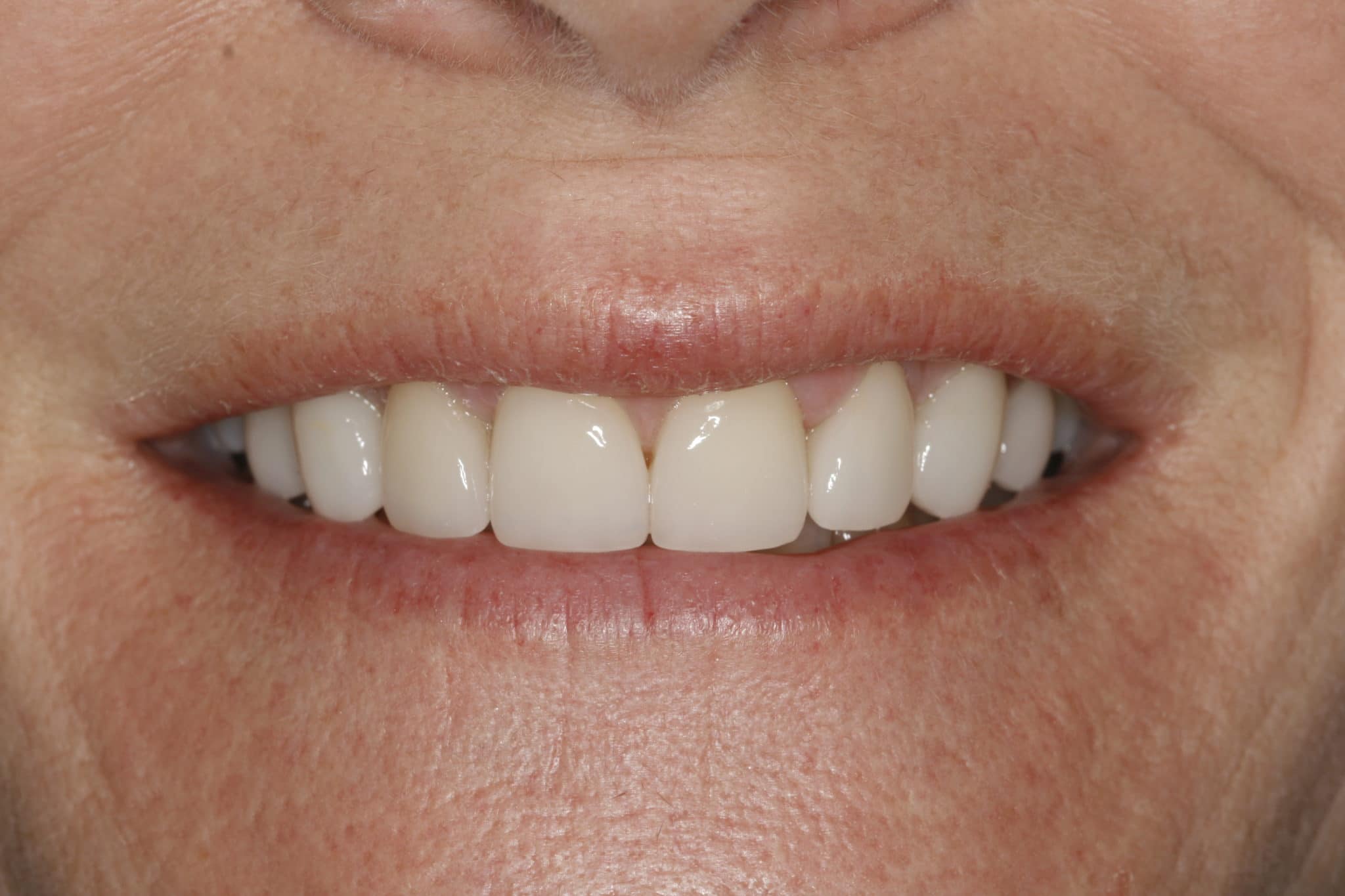 Can TMJ Pain, Overbite, and Smile Be Corrected Without Braces?