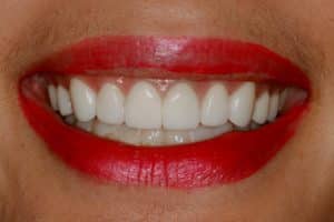 Can Porcelain Veneers Be Used to Make My Small Teeth Bigger?