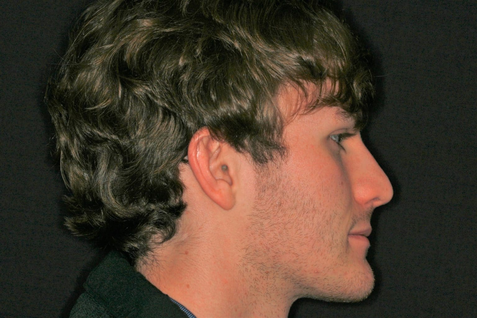 Alternatives to Jaw Surgery for TMJ and Overbites