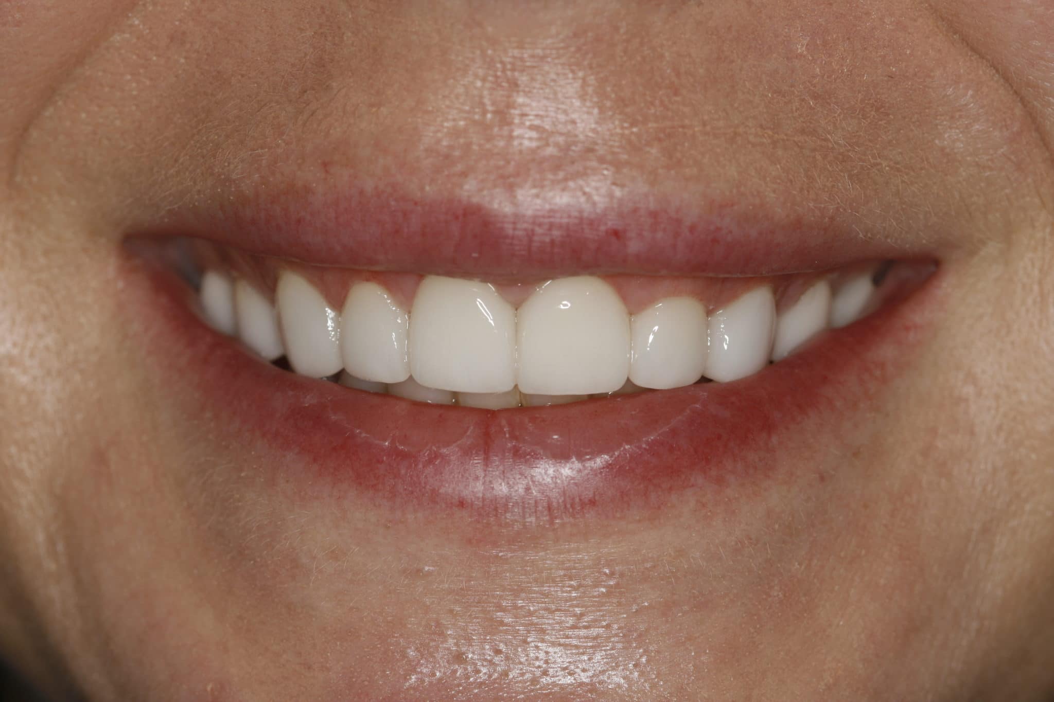 Porcelain Veneers A Beautiful Way to Fix Broken Teeth and