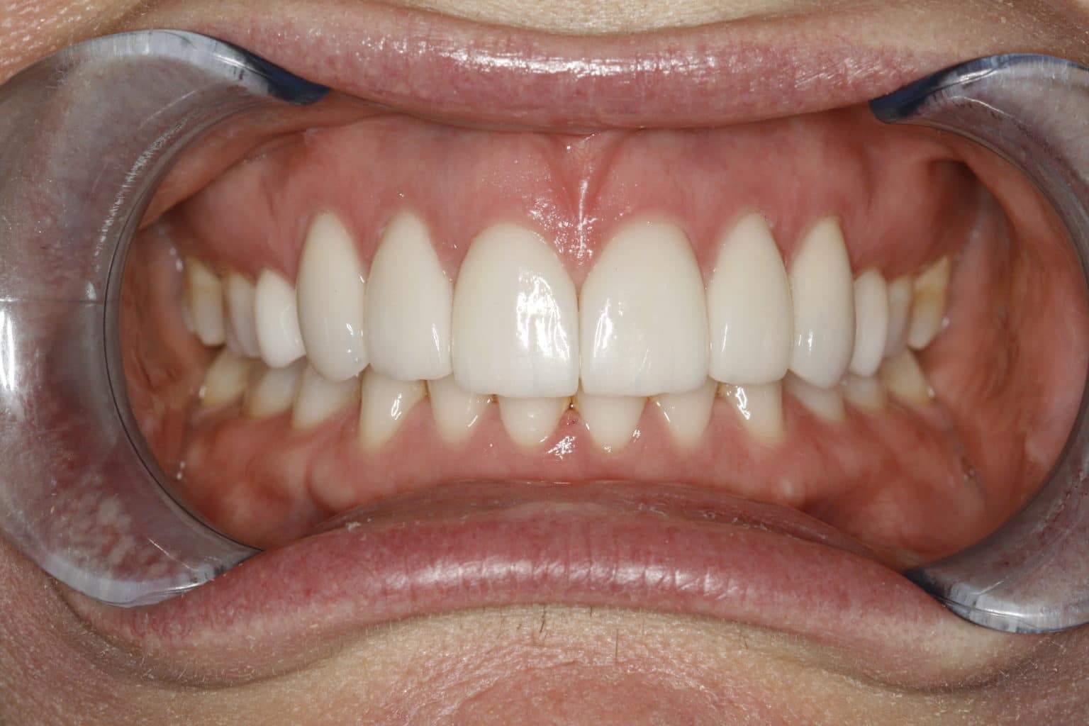 Porcelain Veneer Smile Design I Konig DDS Houston Cosmetic Dentistry