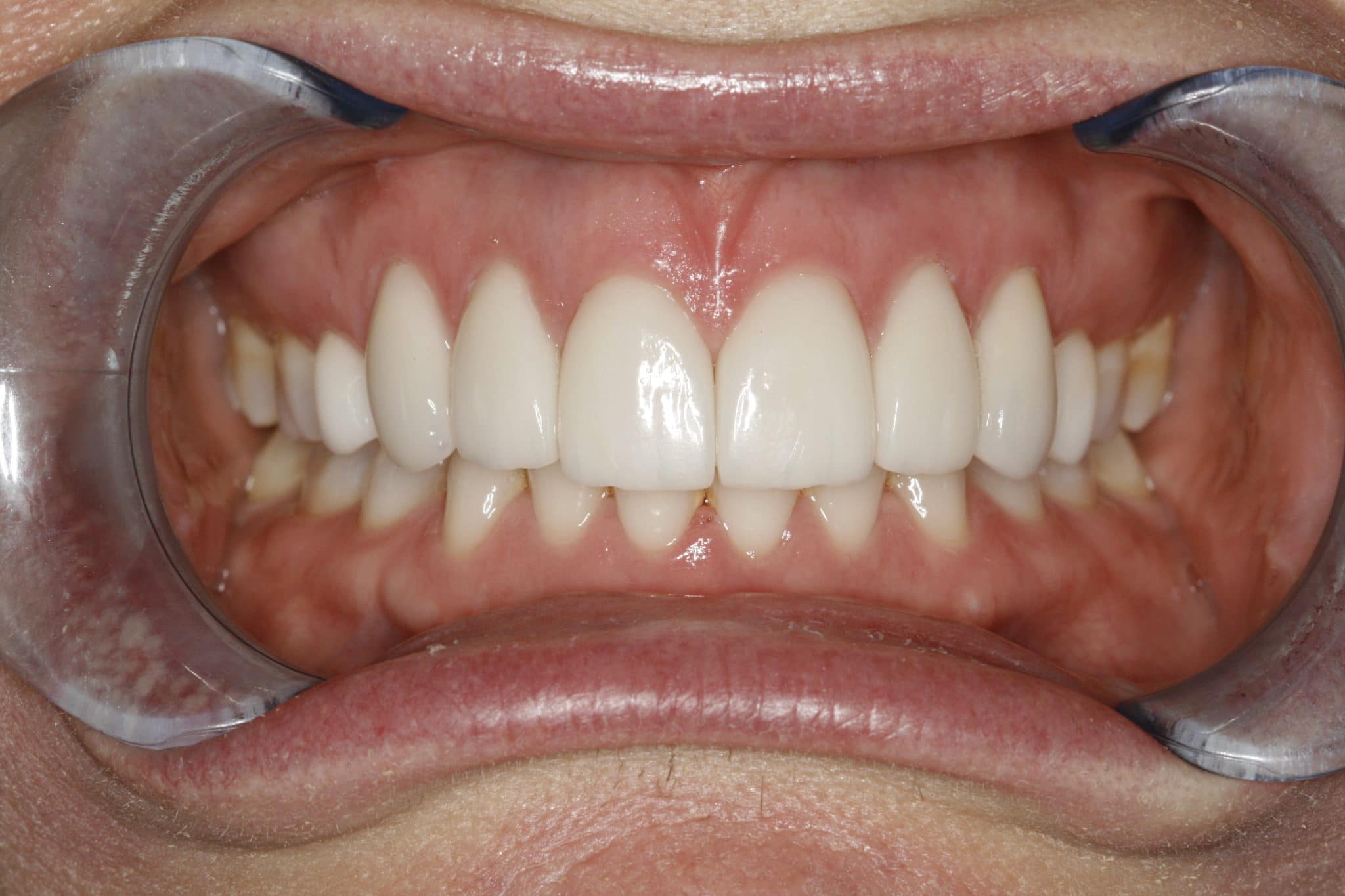 Porcelain Veneer Smile Design I Konig DDS Houston Cosmetic Dentistry