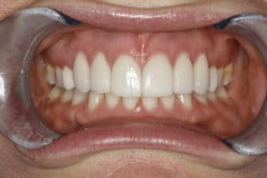 Veneers